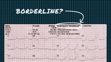 borderline ecg meaning and implications